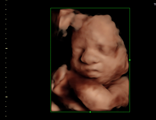 3D ultrasound image at 29 weeks